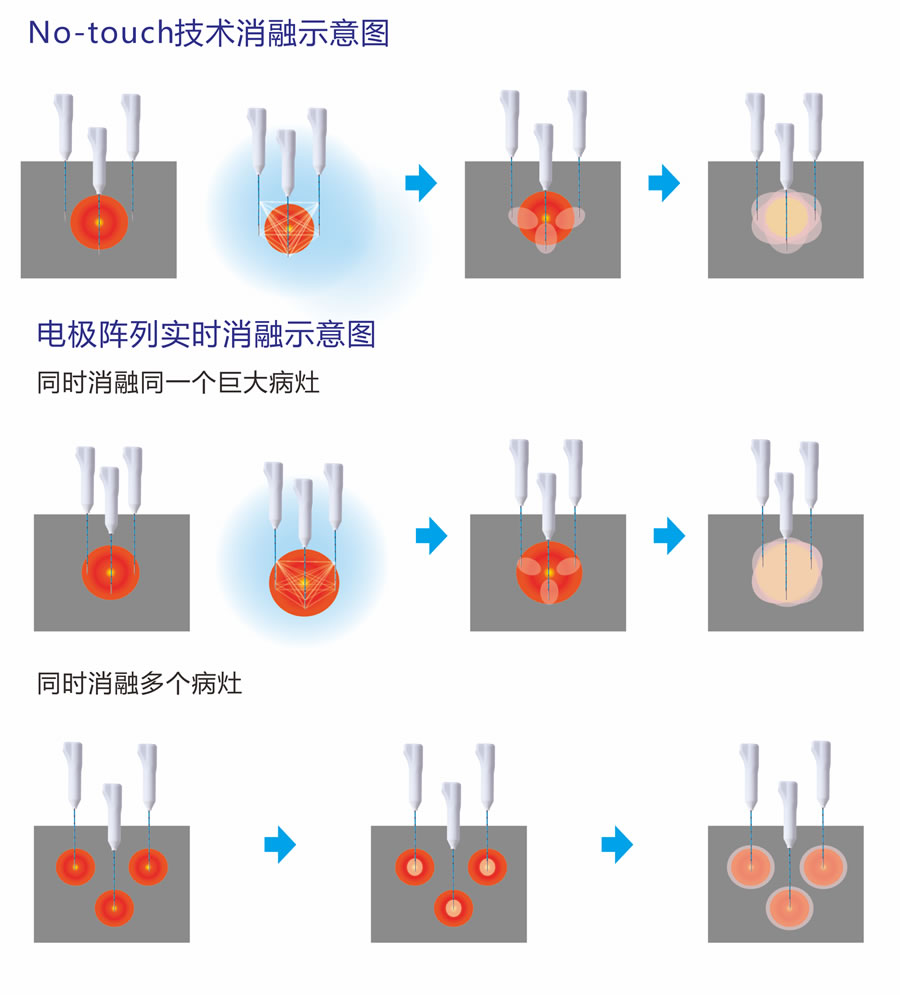 射频消融系统-冷循环 射频消融系统-冷循环