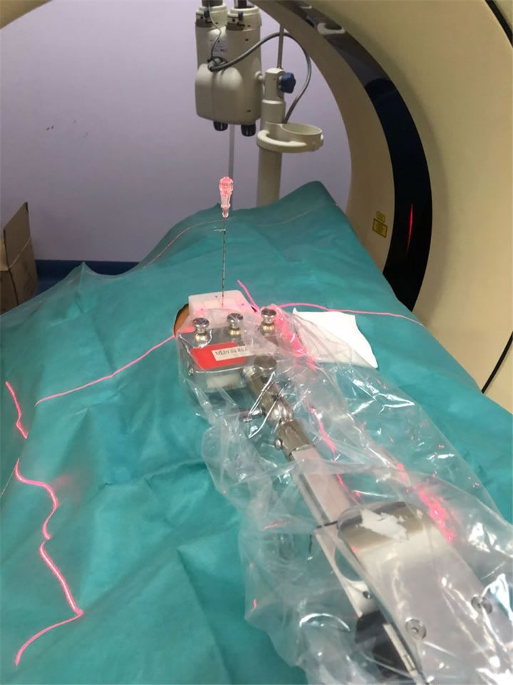 经典病例之穿刺模板引导肺小结节同针道活检消融4