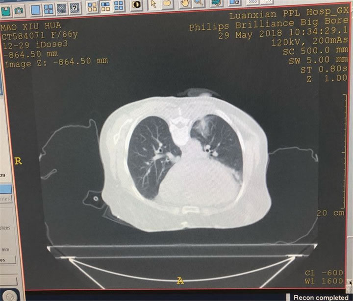 经典病例之穿刺模板引导肺小结节同针道活检消融14