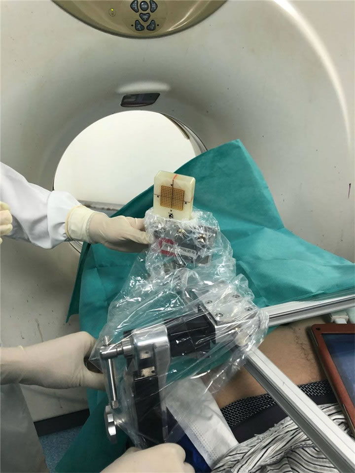唐山市人民医院陈宝明教授团队采用共面模板穿刺技术行肺小结节射频消融一例分享2